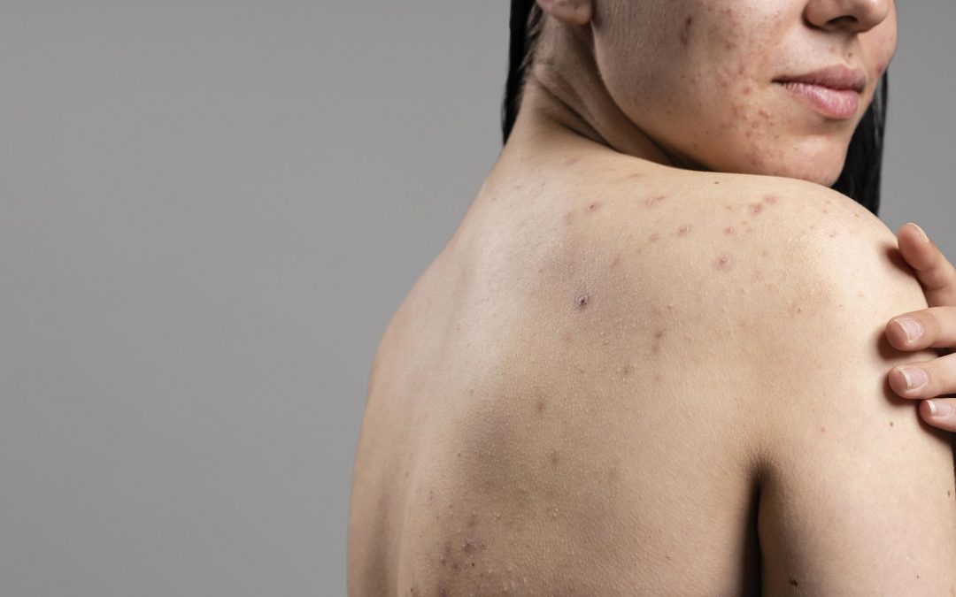 Jak pokonać trądzik hormonalny? Poznaj wskazówki